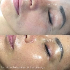Herbal skin peeling 10